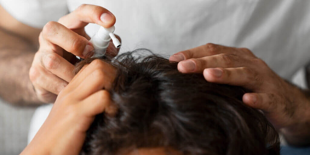 tratamiento minoxidil